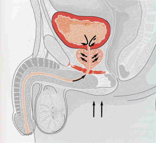 Lėtinis prostatitas