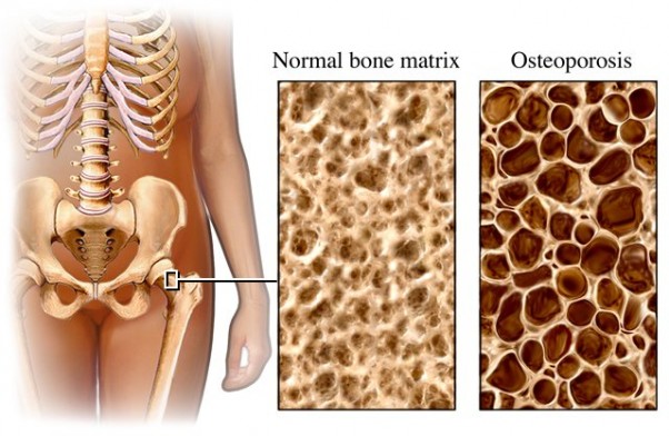 Osteoparozė