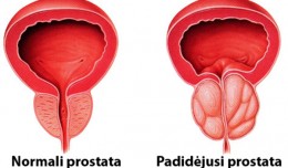 Lėtinis prostatitas